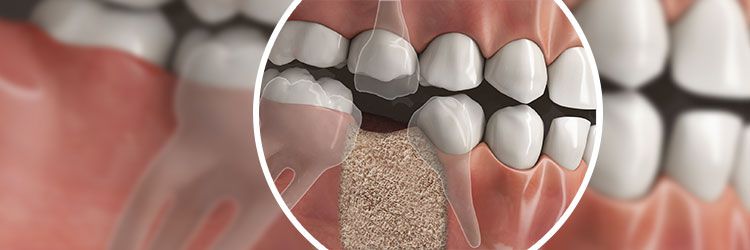 Problem Zahnverlust: Was passiert da?